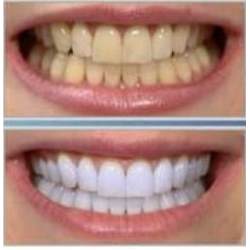 Blanqueamiento dental