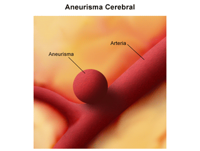 Aneurisma