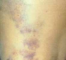 Hematoma