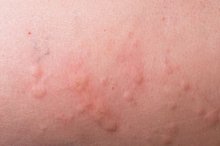 Anafilaxia