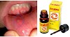 Pyralvex sirve para quitar las llagas, úlceras, de la boca. (Muguet, afta, candidiasis oral)